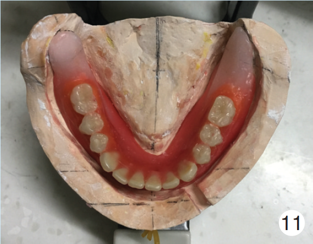 alveolar ridge,sociolinguistics into single complete denture with mandibular alveolar ridge