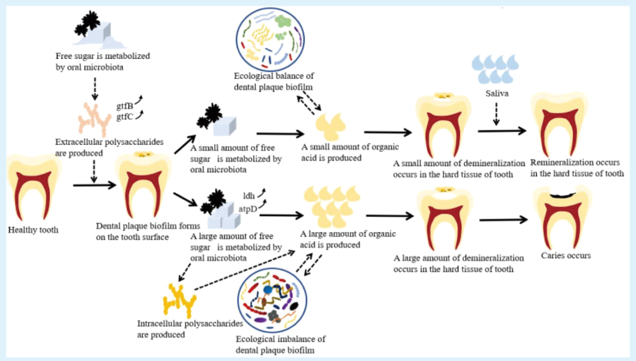 Research progress on the relationship between free sugars and caries