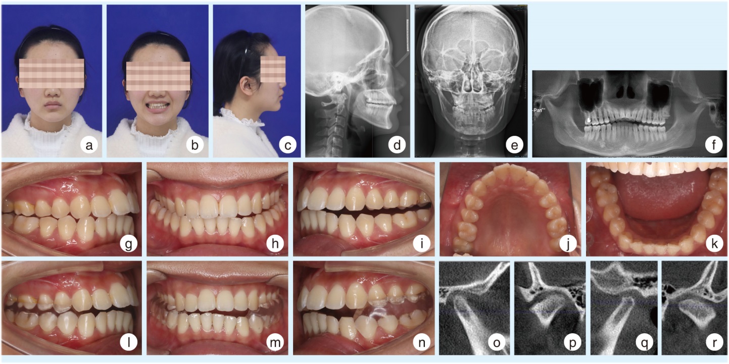 关节盘复位术联合正畸治疗颞下颌关节紊乱病伴偏颌患者1例及文献回顾