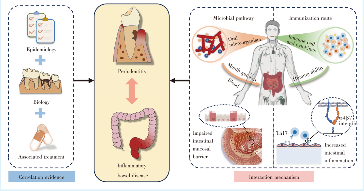 Research progress on association between periodontitis and inflammatory  bowel disease